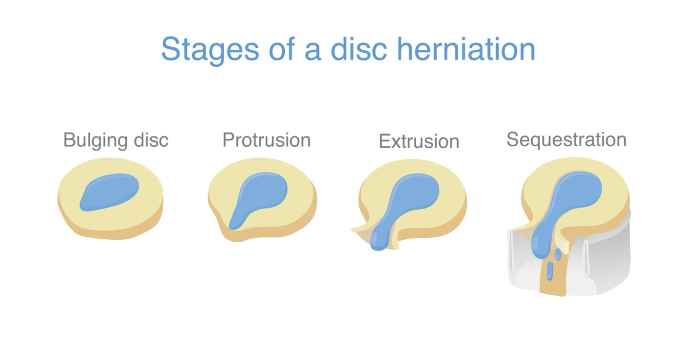 Diagram showing the stages of a disc herniation