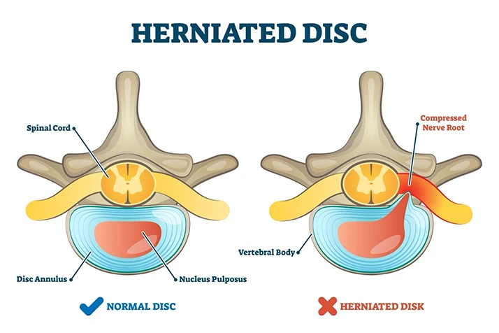 Chiropractic Clive IA Herniated Disc